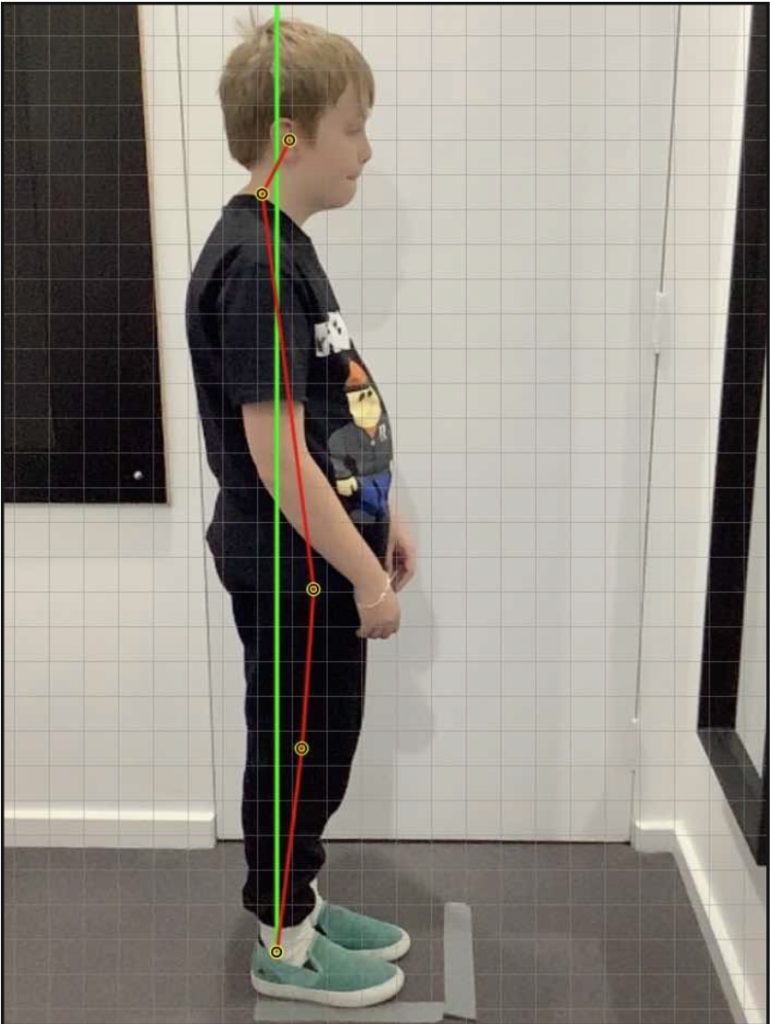 Improvement in an 11-year-old Male With ADHD, Autism Spectrum Disorder and Ehlers-Danlos Syndrome -