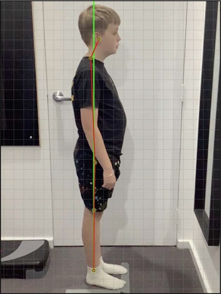 Improvement in an 11-year-old Male With ADHD, Autism Spectrum Disorder and Ehlers-Danlos Syndrome -