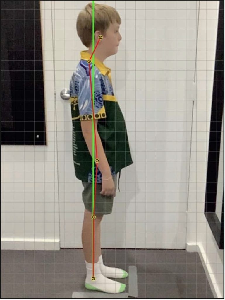 Improvement in an 11-year-old Male With ADHD, Autism Spectrum Disorder and Ehlers-Danlos Syndrome -